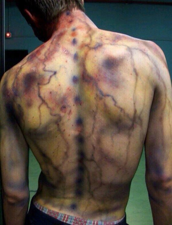 Lidé, kteří přežili zásah bleskem, mají na kůži neobvyklé vzory. Říká se jim "Lich...