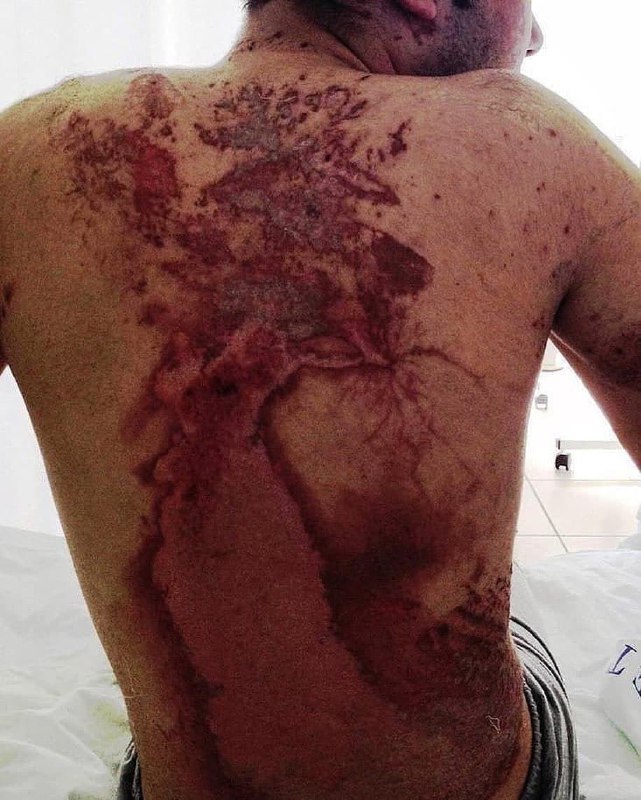 Lidé, kteří přežili zásah bleskem, mají na kůži neobvyklé vzory. Říká se jim "Lich...