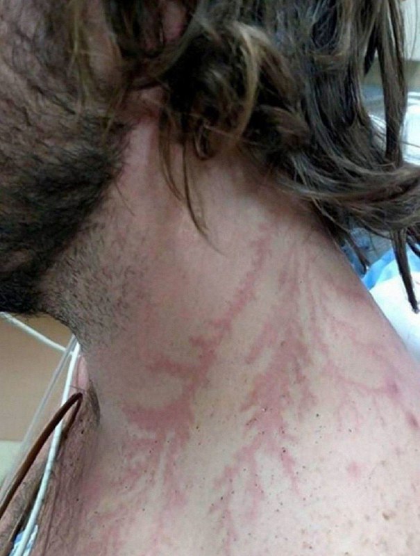 Lidé, kteří přežili zásah bleskem, mají na kůži neobvyklé vzory. Říká se jim "Lich...