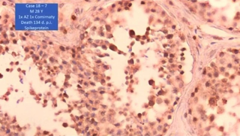 🇩🇪 NĚMECKO, Dr. Arne Burkhardt: Sperma je u "očkovan&yacute;ch" zcela nahrazeno Spike pr...