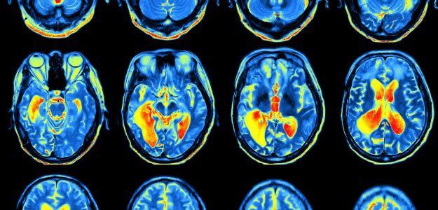 Neurologické poruchy jsou stále častějšíZa poslední tři desetiletí se počet lidí, kteří...
