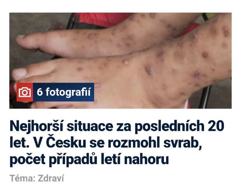 🇨🇿Případů svrabu v Česku podle dat Státního zdravotního ústavu dál přibývá. Za pů...