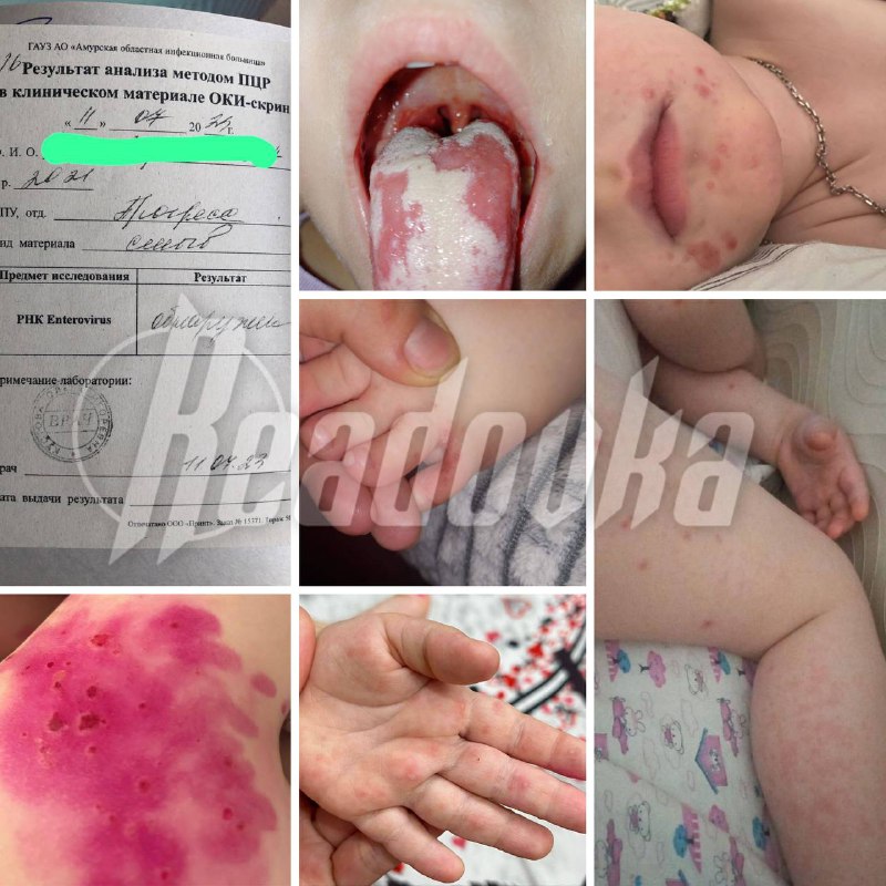 Takto vypadají děti, které chytily infekci ve školce v regionu Amur - podle oficiální verze d?...